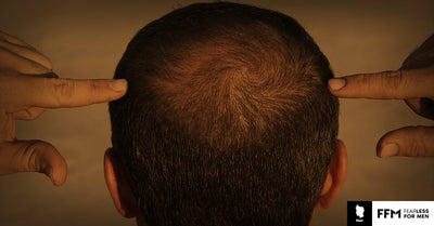 ¿Qué causa la caída del cabello en los hombres?